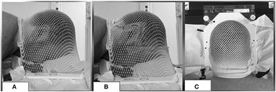 Dosimetric Predictors of Acute and Chronic Alopecia in Primary Brain Cancer Patients Treated With Volumetric Modulated Arc Therapy